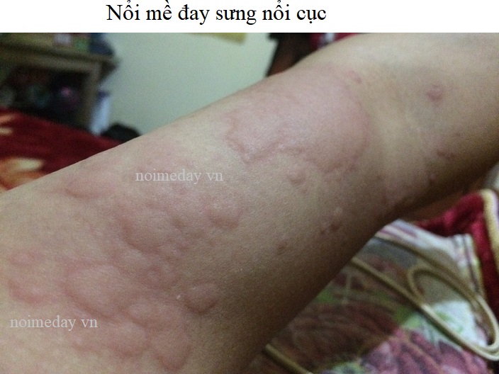 Nổi mề đay sưng nổi cục